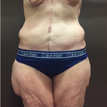 Body Contouring After Photo by Owen Reid, MD; Vancouver, BC - Case 47962