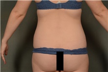 Liposuction Before Photo by Ellen Janetzke, MD; Bloomfield Hills, MI - Case 47971