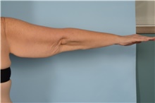 Arm Lift Before Photo by Ellen Janetzke, MD; Bloomfield Hills, MI - Case 48352