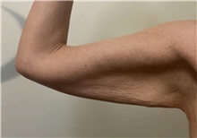 Arm Lift Before Photo by Owen Reid, MD; Vancouver, BC - Case 48367