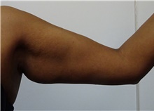 Arm Lift Before Photo by Owen Reid, MD; Vancouver, BC - Case 48368