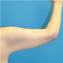 Arm Lift After Photo by Joshua Cooper, MD; Seattle, WA - Case 48376