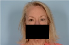 Eyelid Surgery After Photo by Ellen Janetzke, MD; Bloomfield Hills, MI - Case 48389