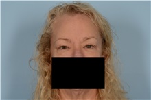 Eyelid Surgery Before Photo by Ellen Janetzke, MD; Bloomfield Hills, MI - Case 48389