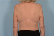 Body Lift After Photo by Ellen Janetzke, MD; Bloomfield Hills, MI - Case 48390