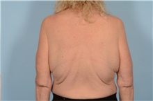 Body Lift Before Photo by Ellen Janetzke, MD; Bloomfield Hills, MI - Case 48390