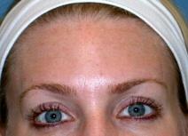 Botulinum Toxin After Photo by Kent Hasen, MD; Naples, FL - Case 6862