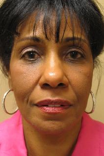 Dermal Fillers After Photo by Lisa Bootstaylor, MD; Atlanta, GA - Case 7204