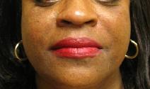 Dermal Fillers After Photo by Lisa Bootstaylor, MD; Atlanta, GA - Case 7931