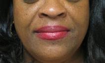 Dermal Fillers Before Photo by Lisa Bootstaylor, MD; Atlanta, GA - Case 7931