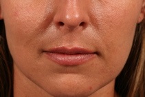 Dermal Fillers After Photo by Michael Bogdan, MD, MBA, FACS; Grapevine, TX - Case 8029