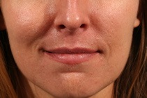 Dermal Fillers Before Photo by Michael Bogdan, MD, MBA, FACS; Grapevine, TX - Case 8029