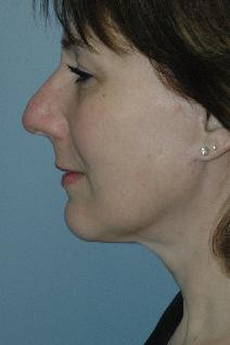 Facelift After Photo by Lucie Capek, MD; Cohoes, NY - Case 8835