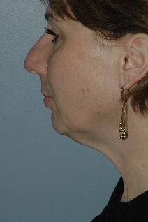 Facelift Before Photo by Lucie Capek, MD; Cohoes, NY - Case 8835