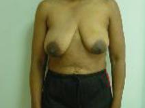 Breast Reconstruction Before Photo by Neal Goldberg, MD; Scarsdale, NY - Case 9012