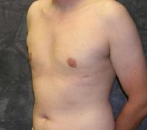 Male Breast Reduction After Photo by Ronald Lohner, MD; Bryn Mawr, PA - Case 9060