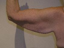 Arm Lift Before Photo by Joseph Fodero, MD; Florham Park, NJ - Case 9088