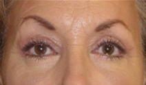 Eyelid Surgery After Photo by Neal Goldberg, MD; Scarsdale, NY - Case 9276