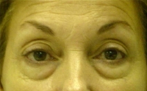 Eyelid Surgery Before Photo by Neal Goldberg, MD; Scarsdale, NY - Case 9276