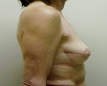 Breast Reconstruction After Photo by Neal Goldberg, MD; Scarsdale, NY - Case 9661