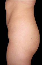 laser assisted lipo after picture