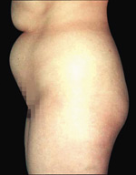 laser assisted lipo before picture