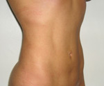 laser assisted lipo after picture