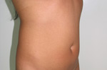 laser assisted lipo before picture