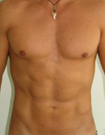 laser assisted lipo after picture