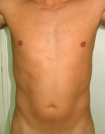 laser assisted lipo before picture