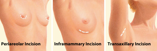 breast augmentation incisions