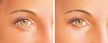 eyelid surgery lower eyelid incision