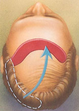 hair transplant