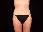 laser assisted lipo after picture