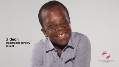 Gideon's Apert Syndrome Journey