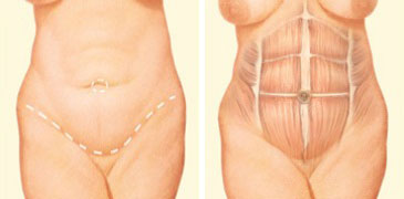 Tummy tuck incision front abdomen