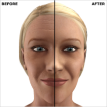 laser skin resurfacing